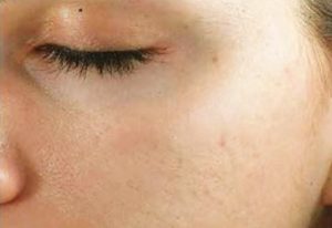 Acne Scars