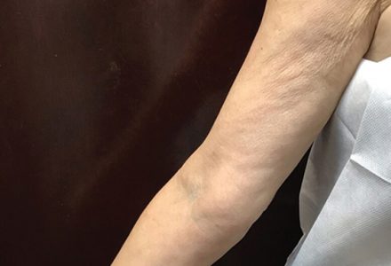Skin Tightening
