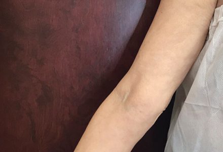 Skin Tightening