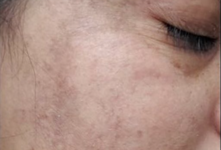 Pigmentation