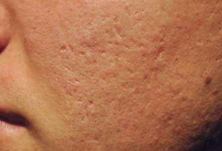 Acne Scars