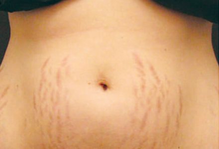 Stretch Marks