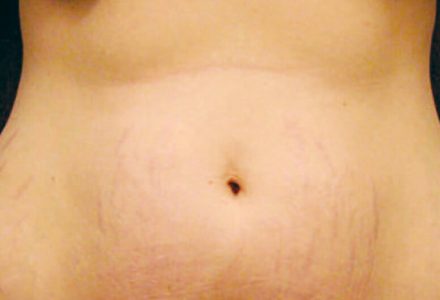 Stretch Marks
