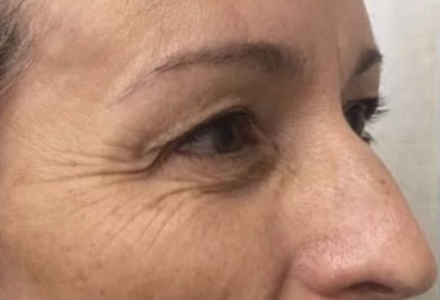 Anti-Aging