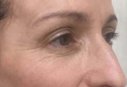 Anti-Aging