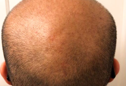 Hair Growth
