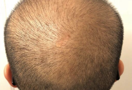 Hair Growth